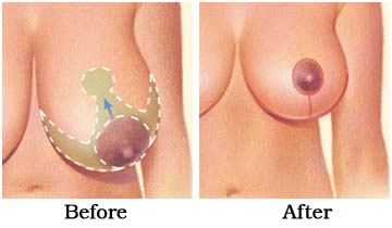 Breast Complications, Breast Implant, Breast Reduction Surgery, Breast Surgery, Breast Surgery Information